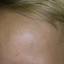 8. Papilloma on the Forehead Pictures