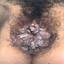 1. Papilloma on the Vulva Pictures
