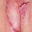 11. Papilloma on the Vulva Pictures
