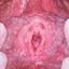 2. Papilloma on the Vulva Pictures