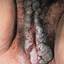 24. Papilloma on the Vulva Pictures