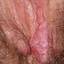 26. Papilloma on the Vulva Pictures