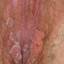29. Papilloma on the Vulva Pictures