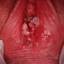 3. Papilloma on the Vulva Pictures