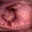 30. Papilloma on the Vulva Pictures
