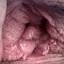 32. Papilloma on the Vulva Pictures