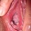 34. Papilloma on the Vulva Pictures