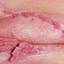 5. Papilloma on the Vulva Pictures