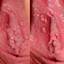 6. Papilloma on the Vulva Pictures