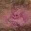 7. Papilloma on the Vulva Pictures