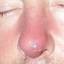 4. Boil in Nose Pictures