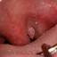 2. Papilloma on Tonsils Pictures