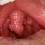 3. Papilloma on Tonsils Pictures
