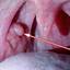 4. Papilloma on Tonsils Pictures