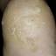 13. Papilloma on the Heel Pictures