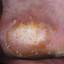 5. Papilloma on the Heel Pictures
