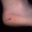 8. Papilloma on the Heel Pictures