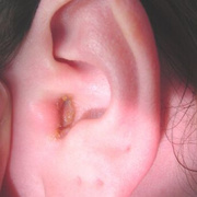 Furuncle in Ear