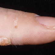 Papilloma on Finger