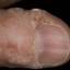 12. Papilloma on Finger Pictures