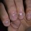 13. Papilloma on Finger Pictures