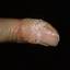 14. Papilloma on Finger Pictures