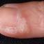 16. Papilloma on Finger Pictures
