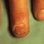 17. Papilloma on Finger Pictures
