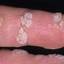 2. Papilloma on Finger Pictures