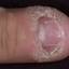 20. Papilloma on Finger Pictures