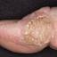 21. Papilloma on Finger Pictures