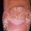27. Papilloma on Finger Pictures
