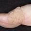 29. Papilloma on Finger Pictures