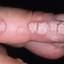 3. Papilloma on Finger Pictures