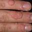 31. Papilloma on Finger Pictures