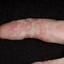 35. Papilloma on Finger Pictures