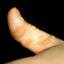 37. Papilloma on Finger Pictures