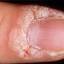 38. Papilloma on Finger Pictures