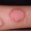 4. Papilloma on Finger Pictures