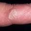 40. Papilloma on Finger Pictures