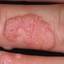 5. Papilloma on Finger Pictures