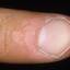 50. Papilloma on Finger Pictures
