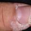 51. Papilloma on Finger Pictures