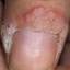 53. Papilloma on Finger Pictures