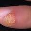 55. Papilloma on Finger Pictures
