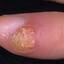 56. Papilloma on Finger Pictures
