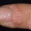 57. Papilloma on Finger Pictures