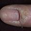 60. Papilloma on Finger Pictures