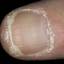 63. Papilloma on Finger Pictures