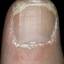 64. Papilloma on Finger Pictures
